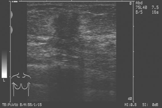 Sono-Brustkrebs
