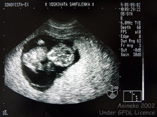 Sono_Fetus